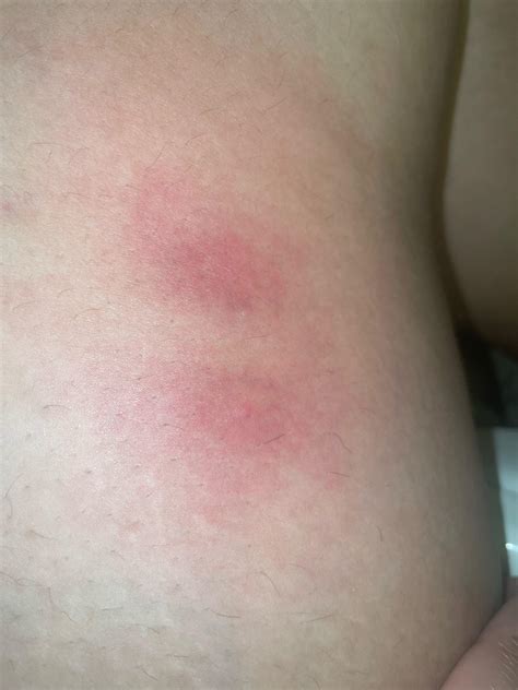 Strange Rash On Inner Thigh Rdiagnoseme