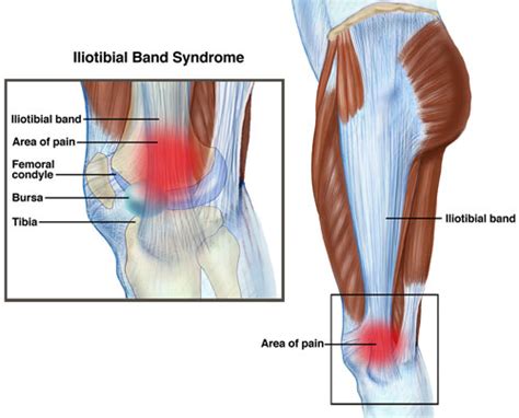 Iliotibial Band Syndrome Specialist In Augusta GA Georgia Clinic Of