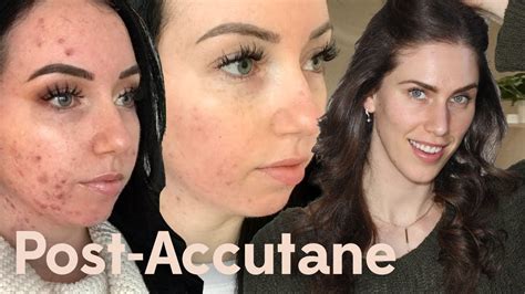 Post Accutane Acne Skincare Routine Youtube