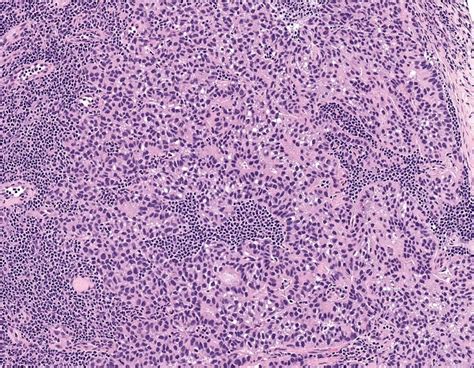 Pathology Outlines Staging