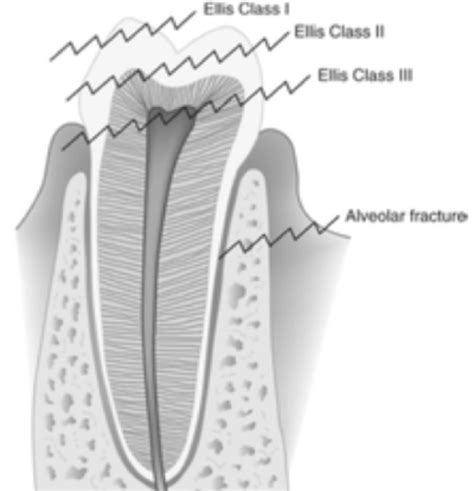 Dental Emergencies Flashcards Quizlet