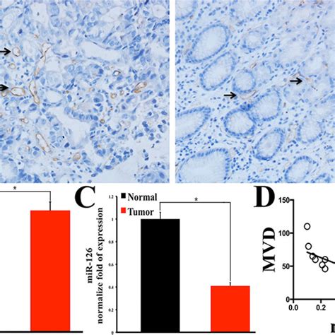 Microvessel Density MVD Is Higher In Gastric Carcinoma Tissue And Is