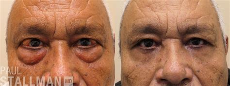 Blepharoplasty Before And After Men