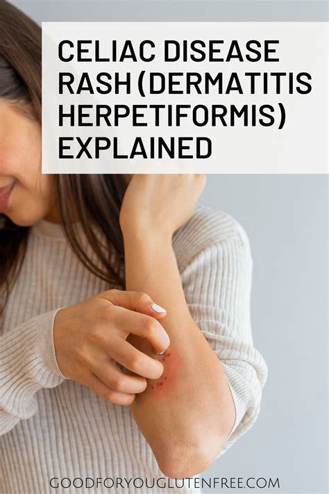 Celiac Disease Rash Dermatitis Herpetiformis Explained Good For You