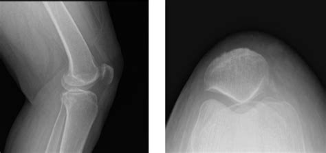 Artroscopia De Rodilla Condroplastia Patelofemoral Y Meniscectom A