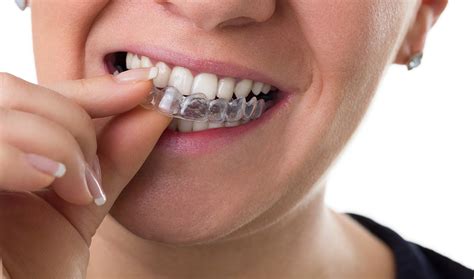 How Does Invisalign Work Why Choose Invisalign