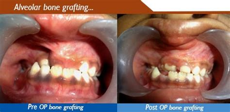 Alveolar bone grafting