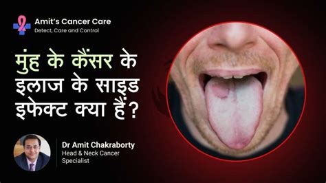 The Truth About Oral Cancer Contagion Dr Amit Chakraborty