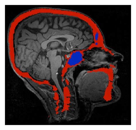 Skull Atlas-to-MRI registration with extensive warping of the skull to ...