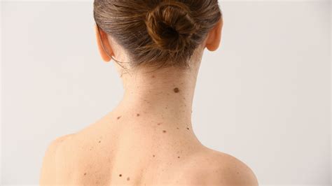 Are moles on body a serious health problem | HealthShots