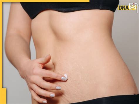 Best Oil For Stretch Marks शरीर पर दिखने वाले स्ट्रेच मार्क्स चंद