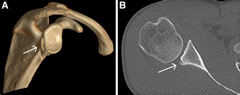 Arthroscopic Posterior Bone Block Stabilization Using A Tricortical