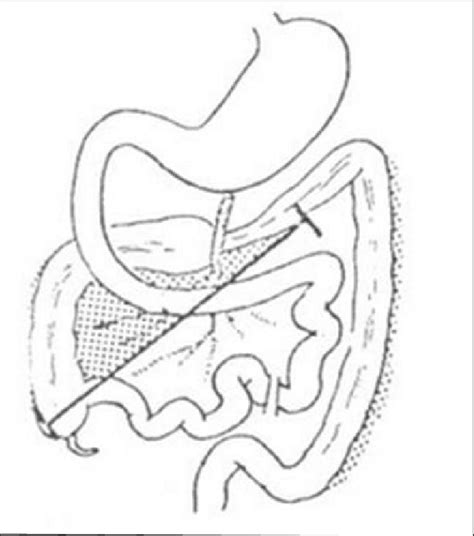 Drawing Showing The Position Of Right Colon In Relation To The Duodenum Download Scientific