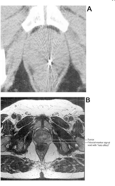 Figure 1 From Magnetic Resonance Imaging In The Radiation Treatment Planning Of Localized