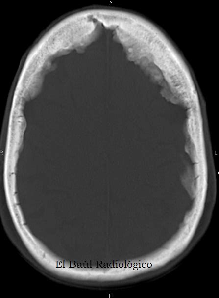 El Ba L Radiol Gico Hiperostosis Endocraneal Idiop Tica Hiperostosis