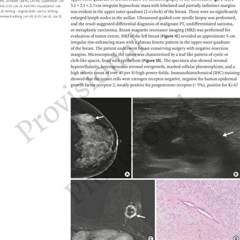 Malignant Phyllodes Tumor Of The Left Breast At The Time Of Initial