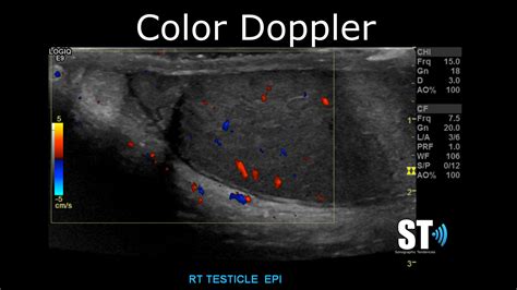 Testicular Scrotal Doppler Protocol Sonographic Tendencies