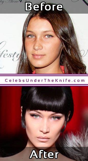 Bella Hadid S Nose Job Before After Photos Ready