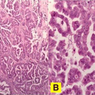 Lung Adenocarcinoma With Micropapillary Pattern Hematoxylin And Eosin