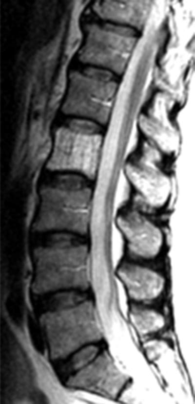 Vertebral Hemangioma Radsource