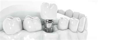 Dental implants process step by step - Dentakay