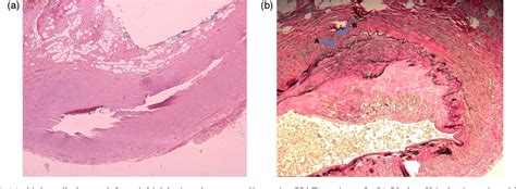 Labial Artery Semantic Scholar