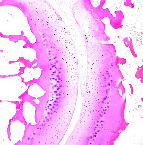 normal metatarsophalangeal mtp joint amputated toe ed uthman