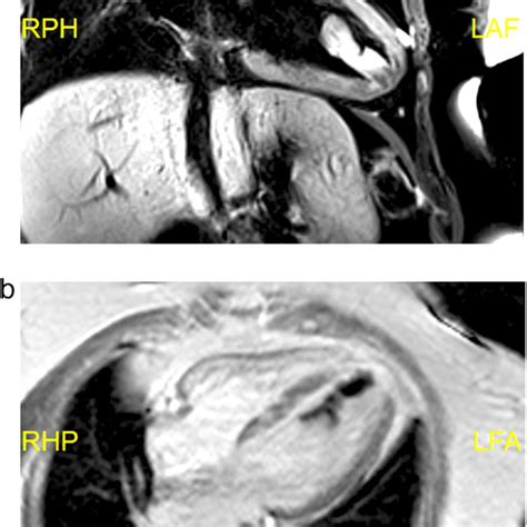 Pdf Large Left Ventricular Thrombus Surgically Resected In A Patient With Normal Ejection A