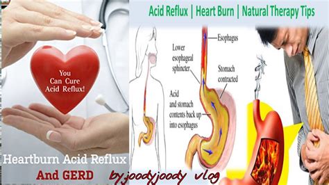 Heartburn And Acid Reflux Acid Reflux The Natural Remedy Youtube