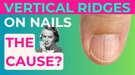 The Real Causes Of Vertical Ridges On Your Nails Youtube