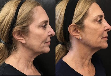 The New Neck Lift We Tried Botox In Our Neck In The Groove