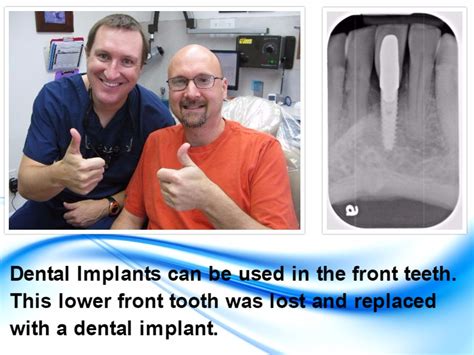 Options To Replace A Missing Tooth Dental Implant Pasadena