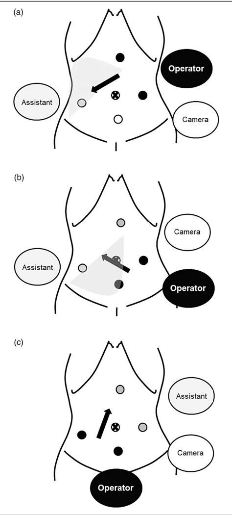 Laparoscopic Right Hemicolectomy With Complete Mesocolic Excision And Central Vascular Ligation