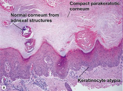 Ch 3 Malignant Tumors Of The Epidermis Flashcards Quizlet