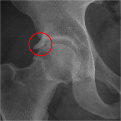 Acetabular Rim Ossification Variants Are Found In Almost Of