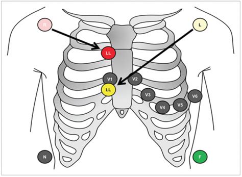 emDOCs.net – Emergency Medicine EducationECG Pointers – The Lewis Lead - emDOCs.net - Emergency ...