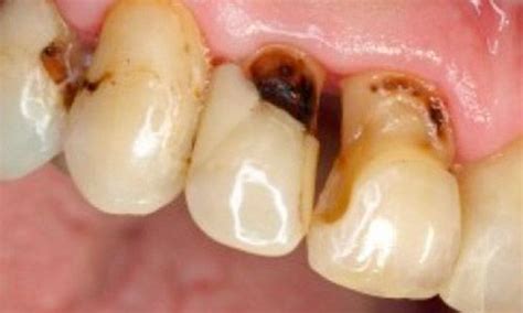 Qué tipos de caries hay y cómo tratarlas Clínica Dental AVODENT