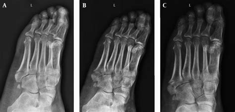 Proximal Fifth Metatarsal Fractures Anatomy Classification Treatment