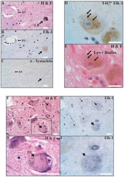 A Classic Lewy Body In A Neuromelanin Containing Substantia Nigra Download Scientific Diagram