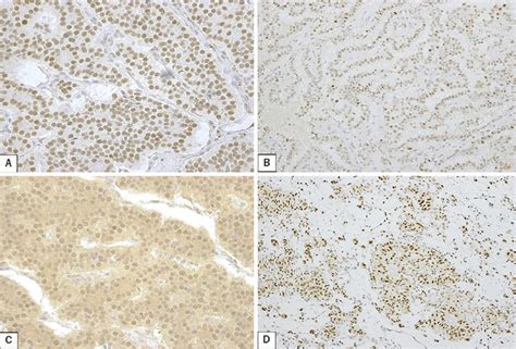 Figure1immunohistochemical Staining Of A Msh2 B Msh6 C Pms2 Download Scientific