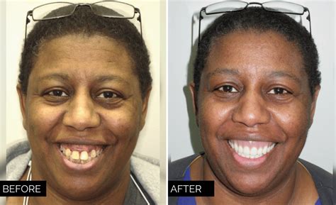 Dentures Before and After Photos - Wilkinson Dental