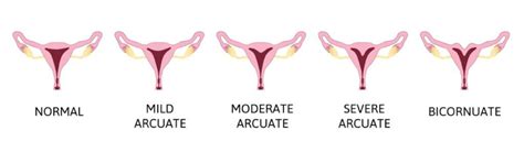 Arcuate Uterus: Causes, Symptoms, Diagnosis Treatment, 45% OFF