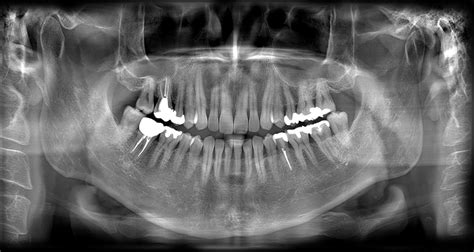 Radiografía panorámica dental ortopantomografía Usos y ventajas