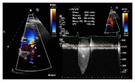 Transthoracic Echocardiography Turbulent Flow On Color Doppler A Was