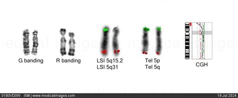 STOCK IMAGE, chromosome 5 abnormalities in cri du chat syndrome cat cry ...