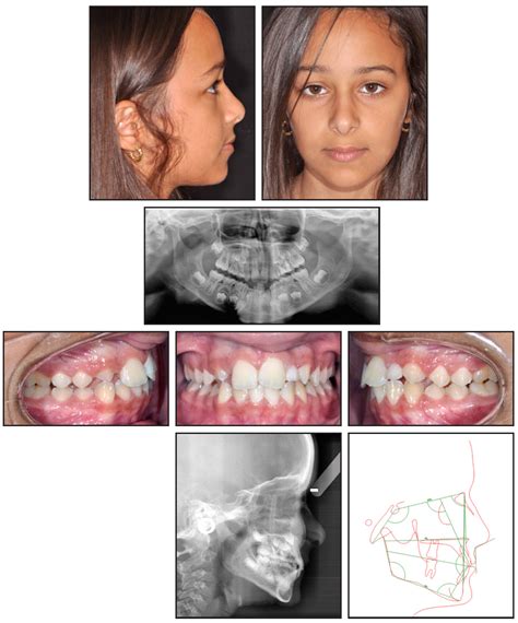 Space Closure In Lateral Incisor Agenesis Using Tads