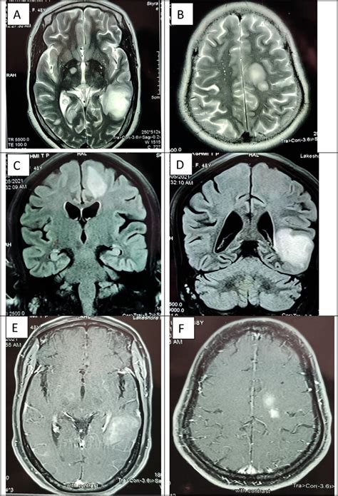 Brain Magnetic Resonance Imaging Mri Findings Pre Treatment