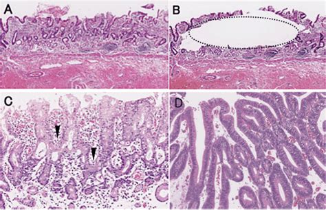 Histology of crawling-type adenocarcinoma (CRA). a Irregularly fused ...