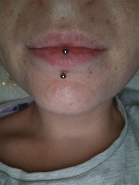 Vertical Labret Irritation Bump R Piercing