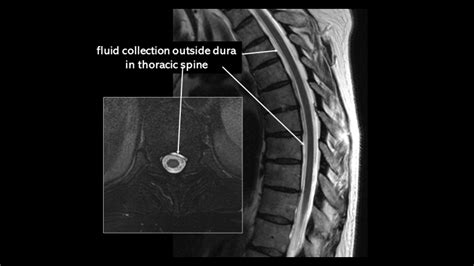 Katie S Spinal Csf Leak Story Spinal Csf Leak Foundation